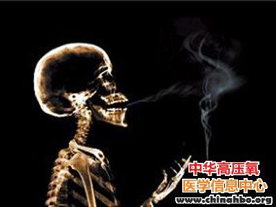 吸烟增加蛛网膜下腔出血风险 重度吸烟女性尤甚