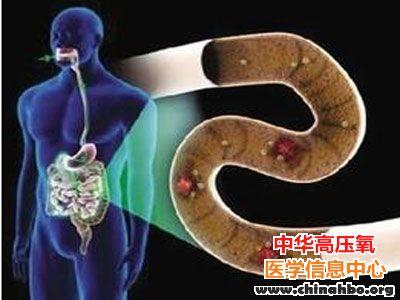 粪便移植疗效喜人