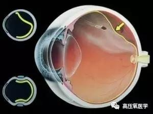 “视网膜剥离”不妨碍高压氧治疗
